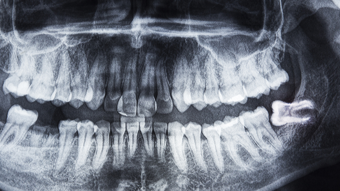 Wisdom Tooth Removal